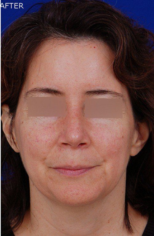 rhinoplasty