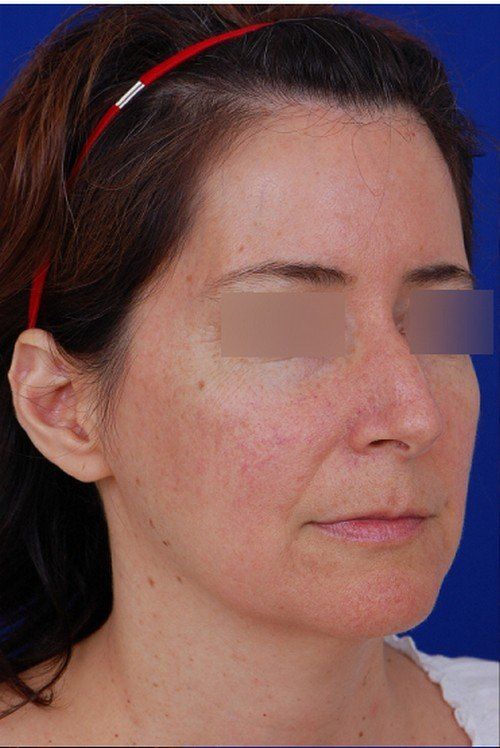 rhinoplasty