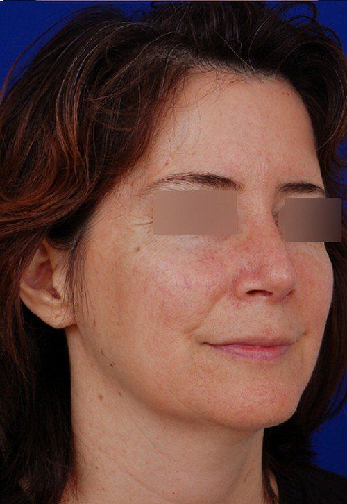 rhinoplasty