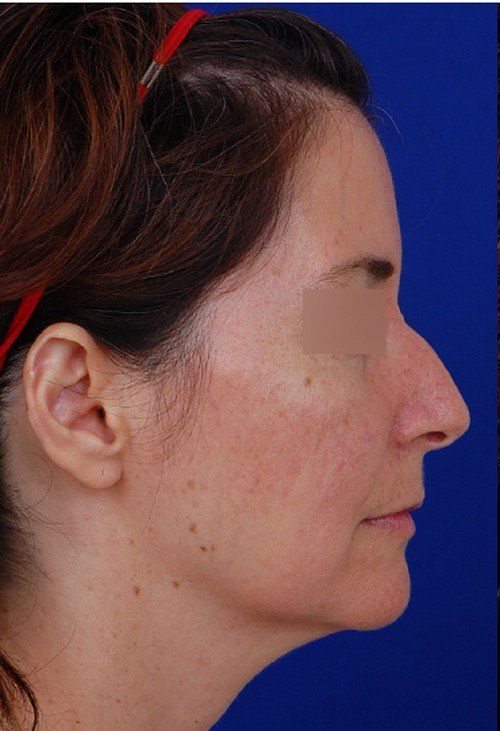 rhinoplasty