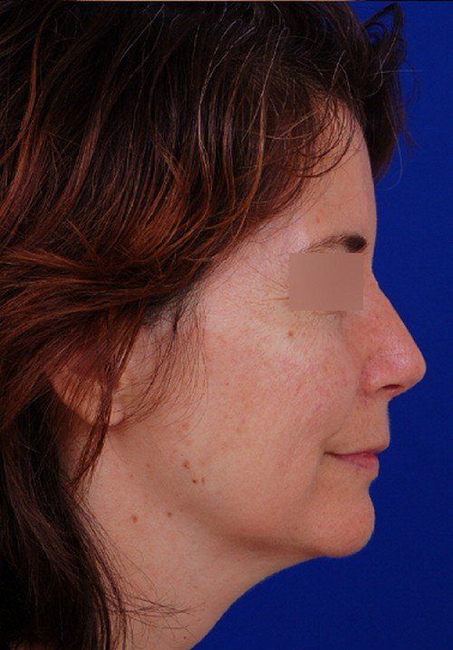 rhinoplasty