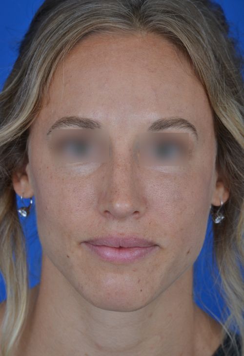 female rhinoplasty