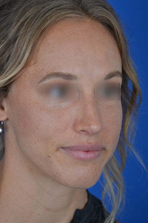 female rhinoplasty