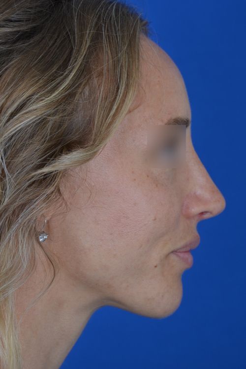 female rhinoplasty