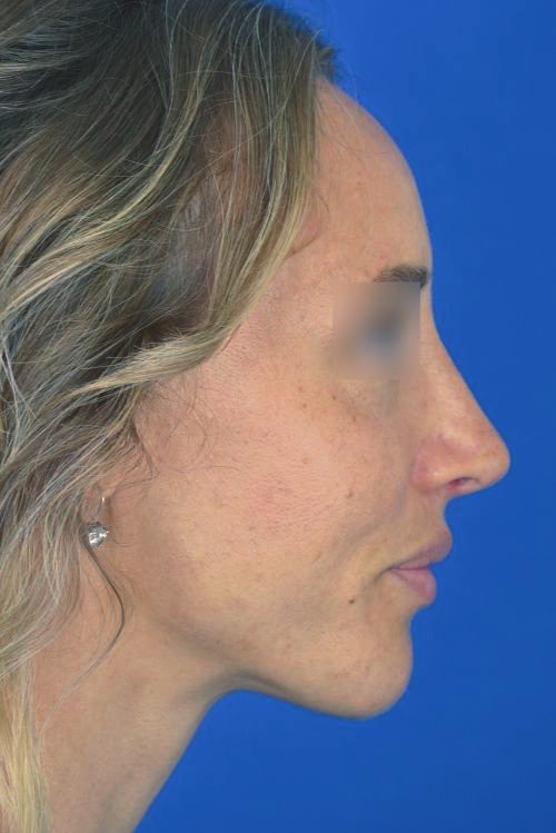 woman after rhinoplasty