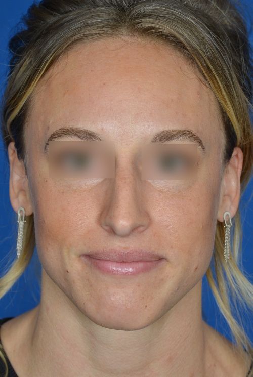 female rhinoplasty