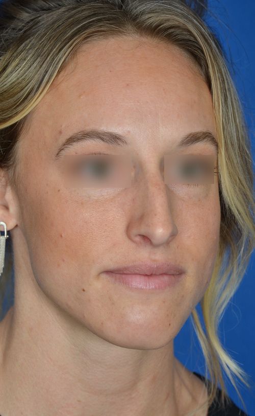 before rhinoplasty