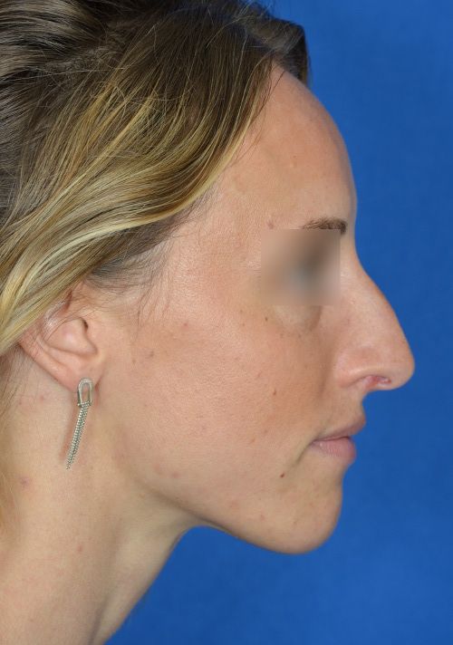 woman before rhinoplasty