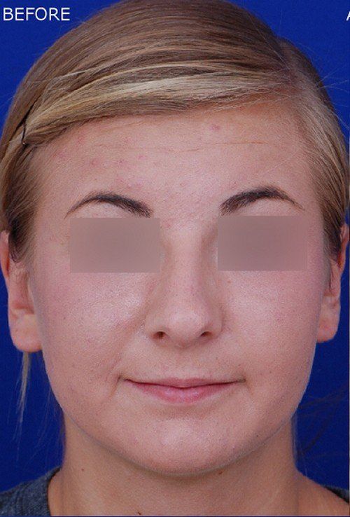 rhinoplasty