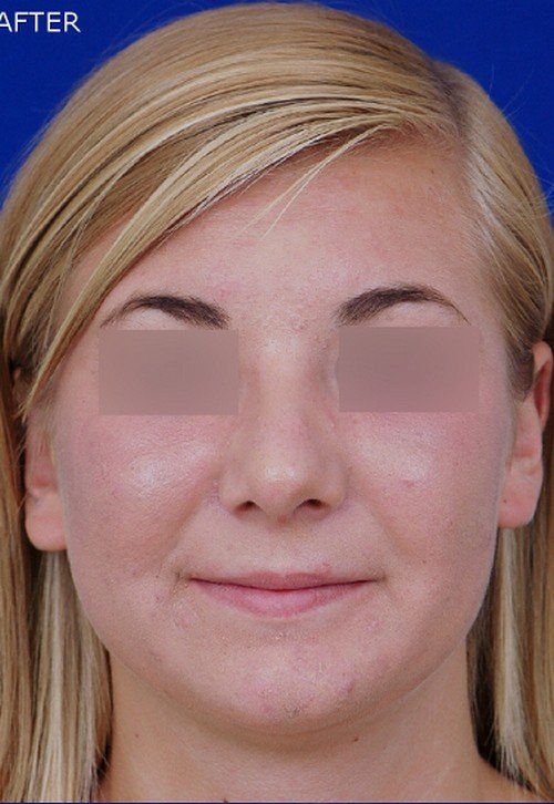 rhinoplasty