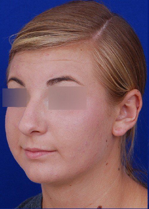 rhinoplasty