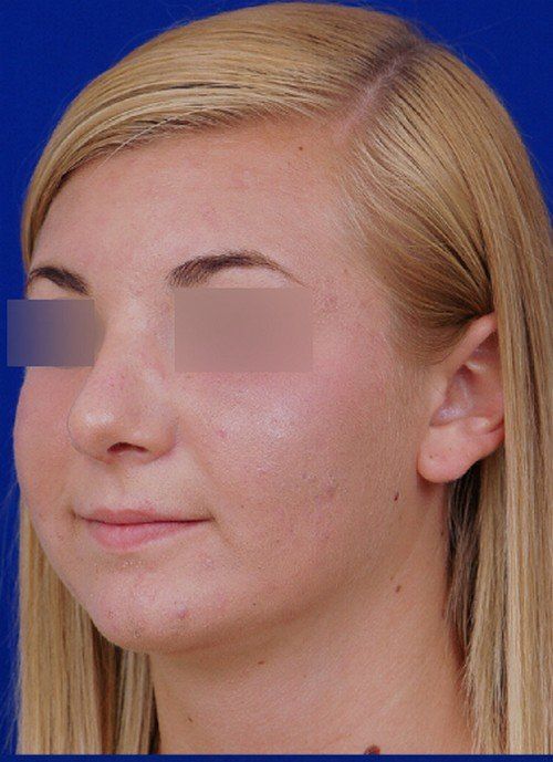 rhinoplasty