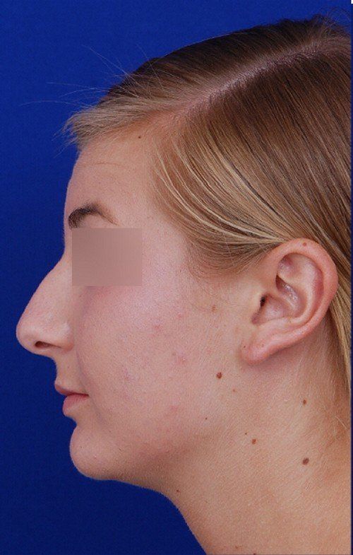 rhinoplasty
