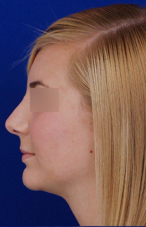 rhinoplasty