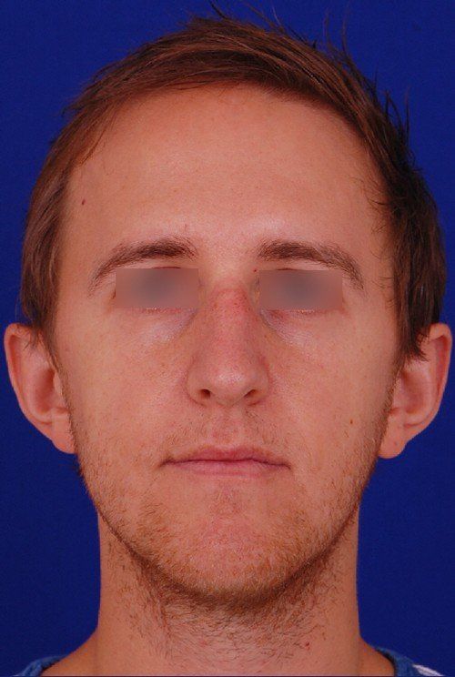 male rhinoplasty