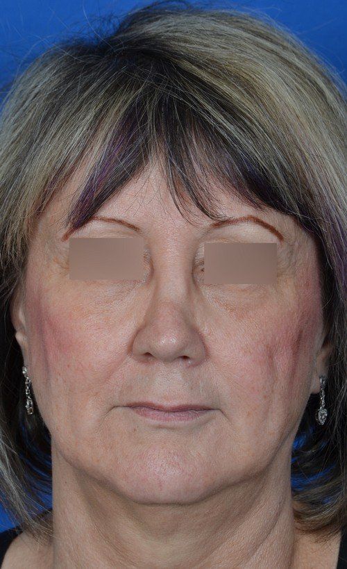 female revision rhinoplasty
