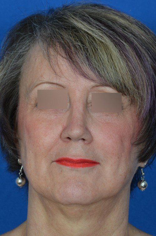 female revision rhinoplasty