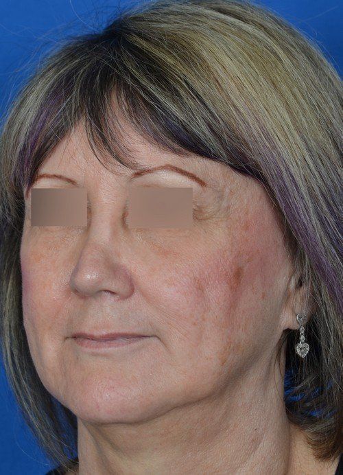 female revision rhinoplasty