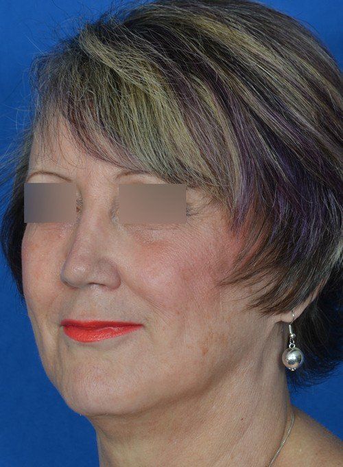 female revision rhinoplasty