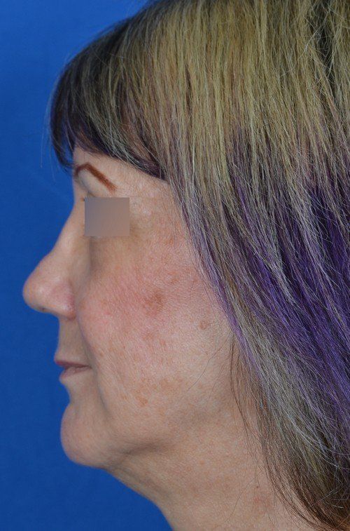 female revision rhinoplasty