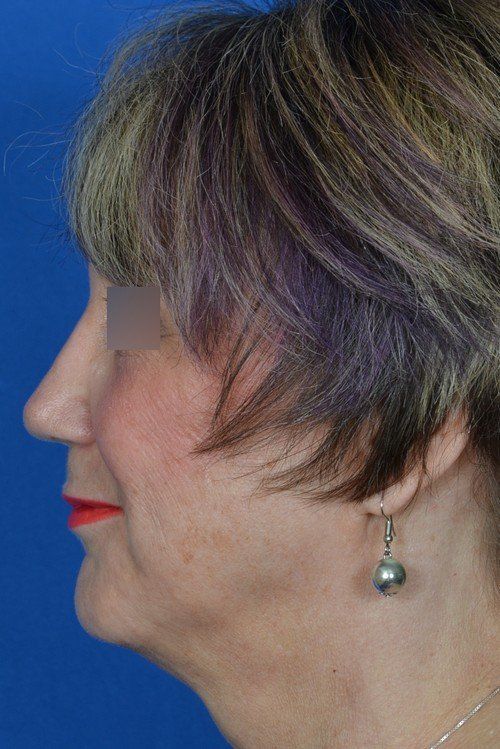 female revision rhinoplasty