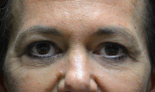 mini facelift before and after