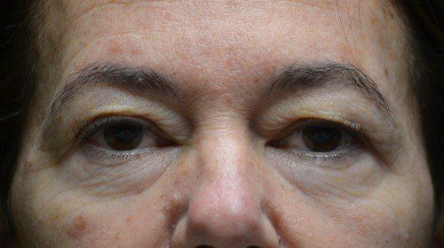 blepharoplasty before and after