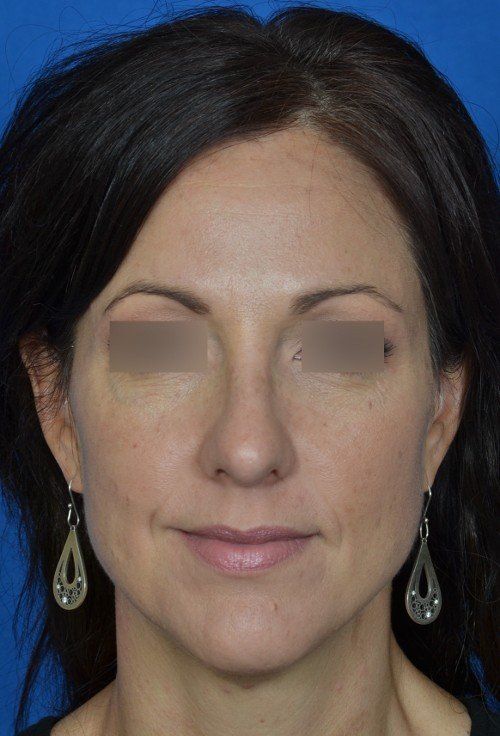 female rhinoplasty