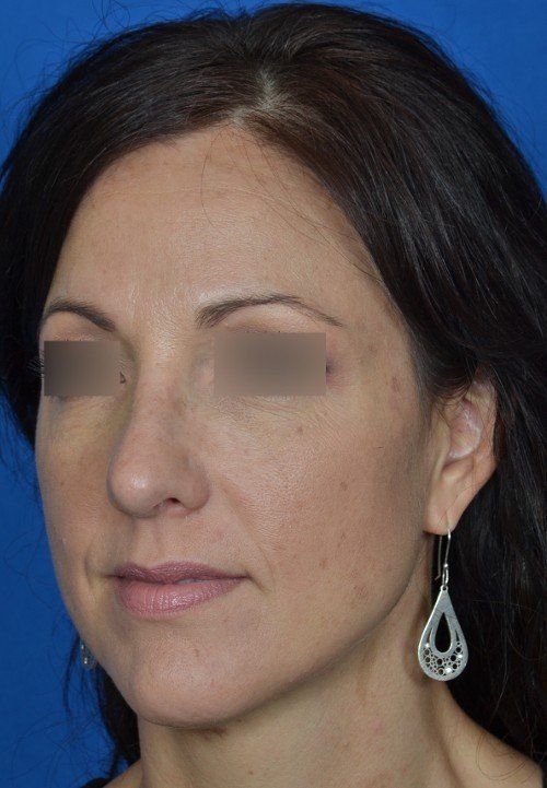 female rhinoplasty