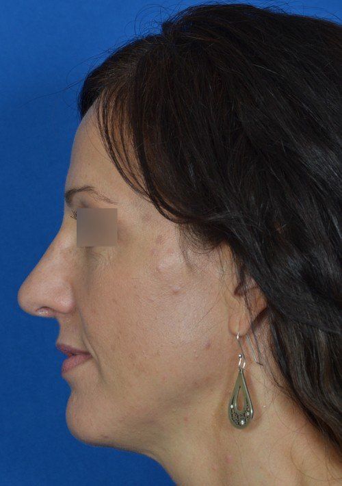 rhinoplasty