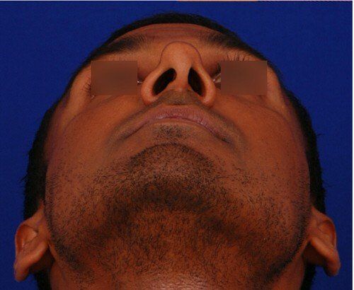 male rhinoplasty