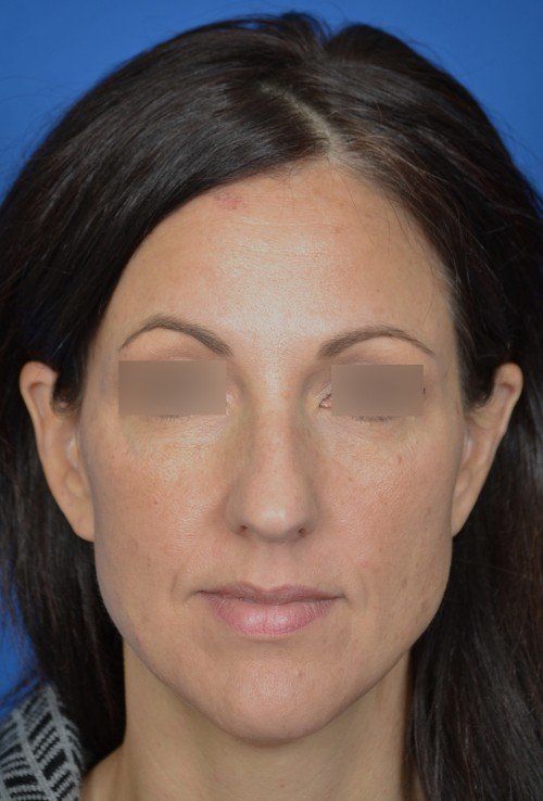 female rhinoplasty