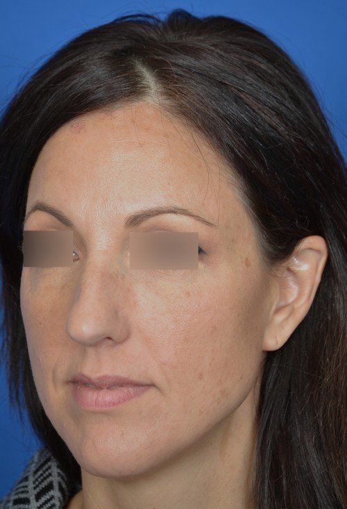 rhinoplasty