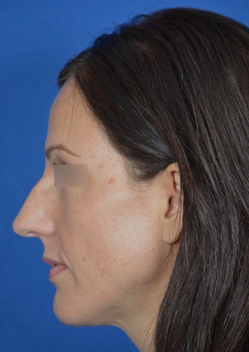 female rhinoplasty