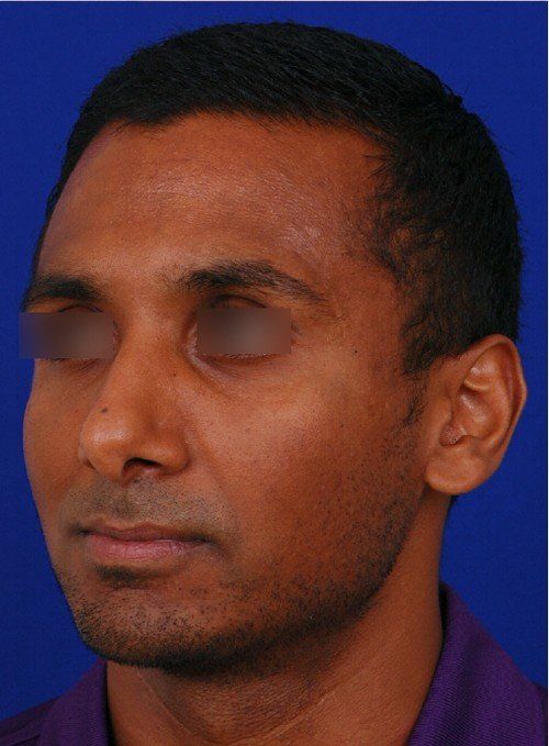 male rhinoplasty