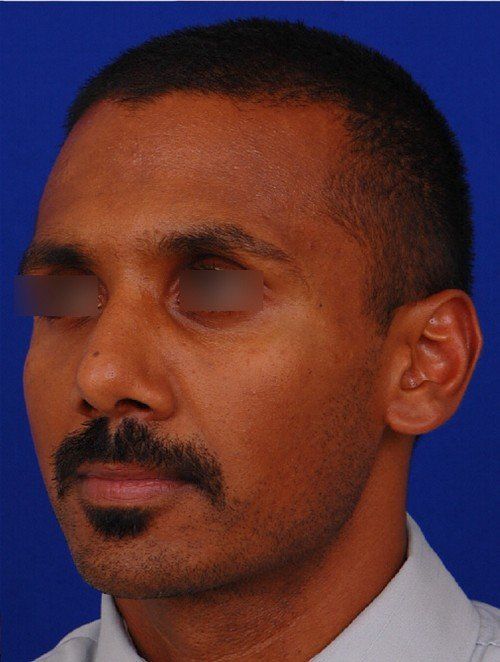 male rhinoplasty after