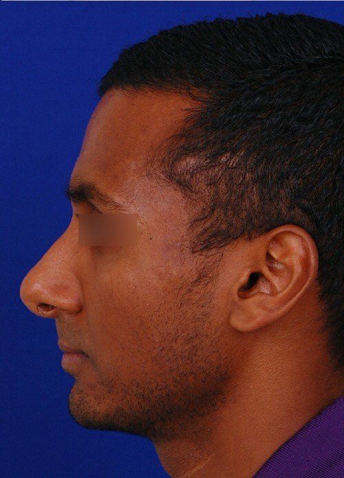 male rhinoplasty