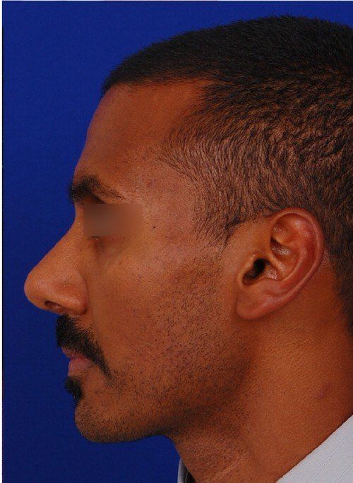 male rhinoplasty after