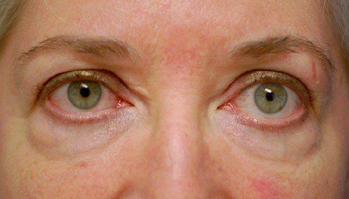 eye bags