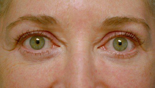 undereye bags gone after blepharoplasty
