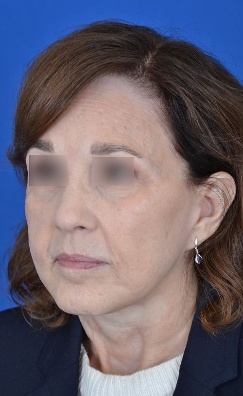 mini facelift before and after
