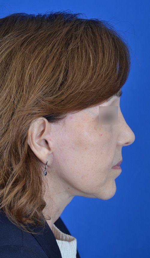 mini facelift before and after