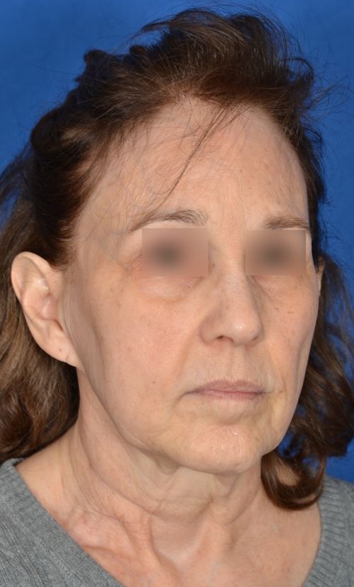 mini facelift before and after