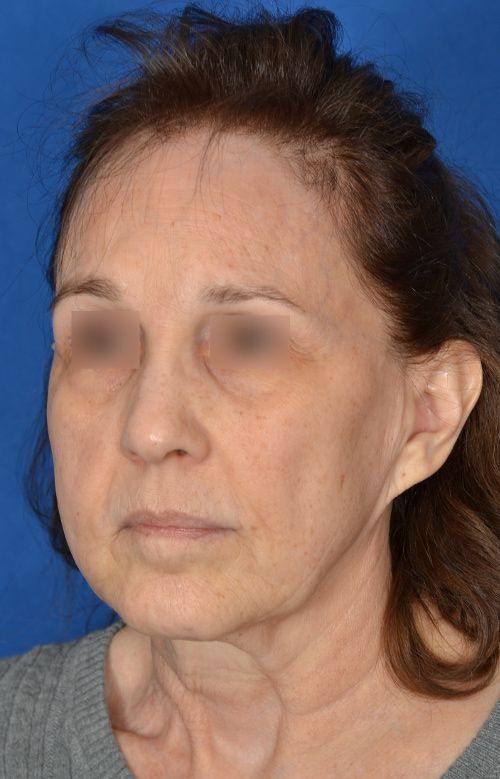mini facelift before and after