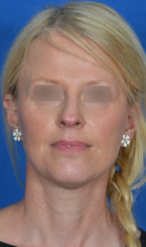 mini facelift before and after