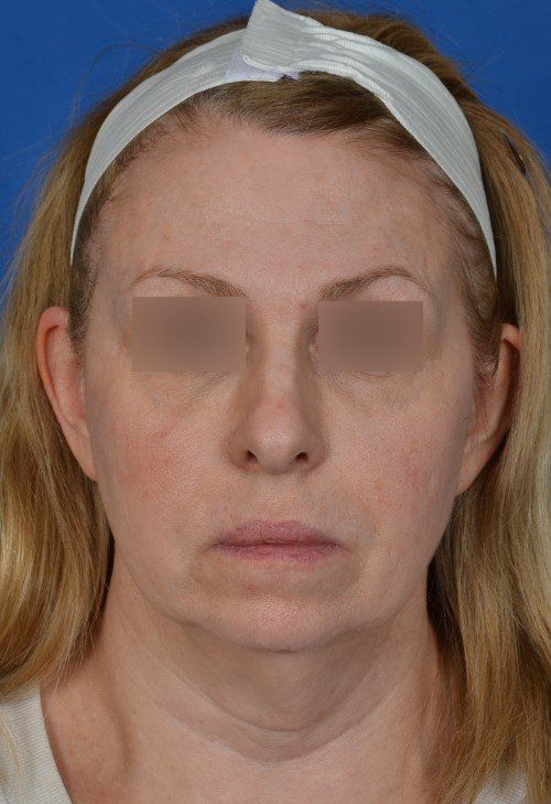 woman before facelift
