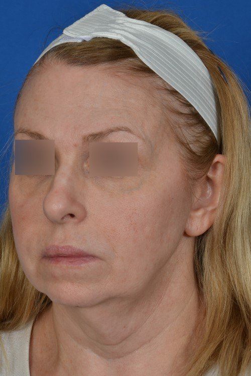 woman before facelift
