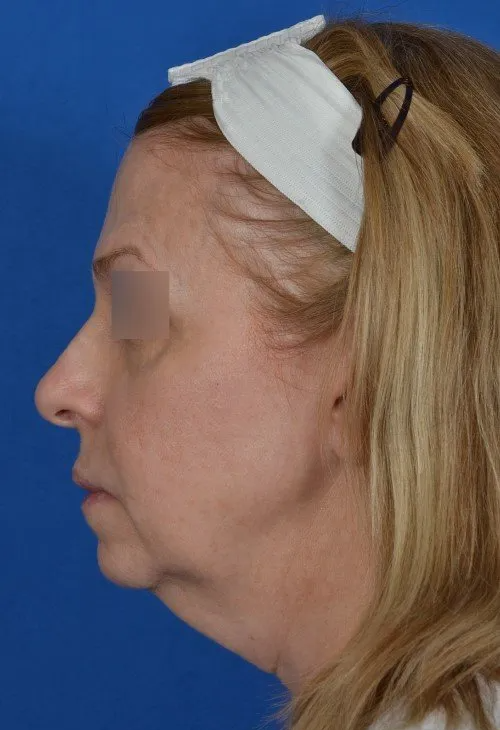 woman before facelift
