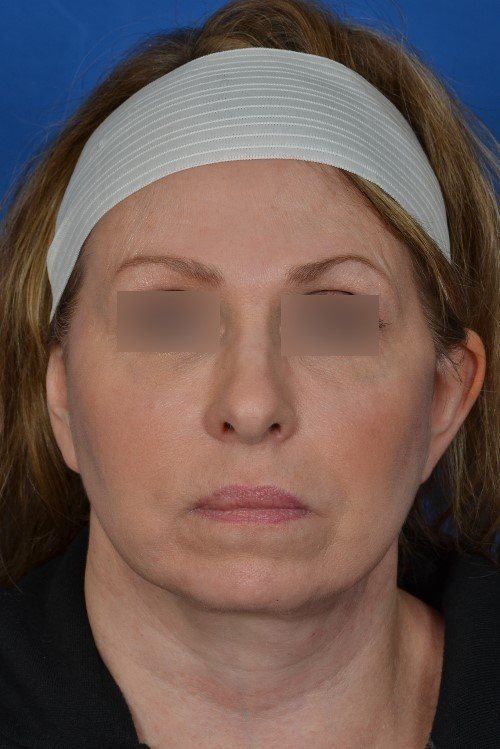 female facelift