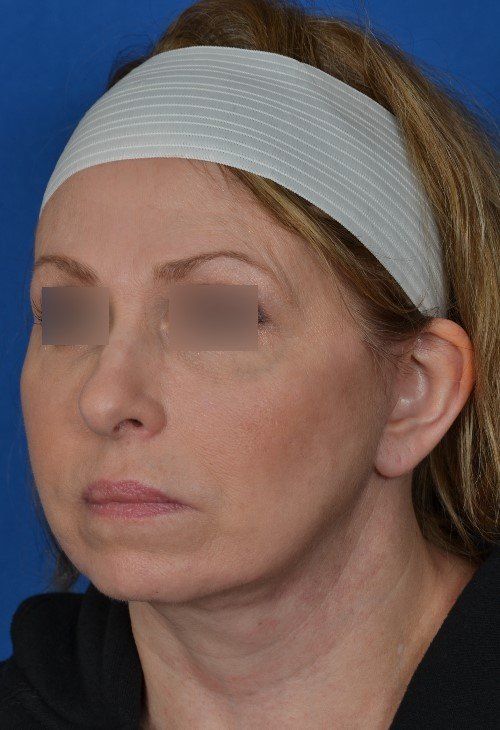 female facelift